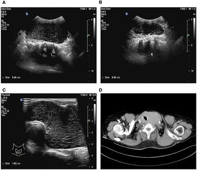 Simultaneous primary thyroid MALT lymphoma and papillary thyroid cancer